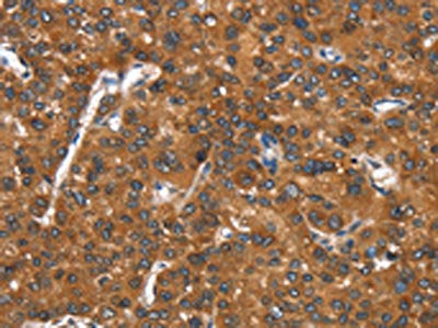 The image on the left is immunohistochemistry of paraffin-embedded Human liver cancer tissue using the antibody Antibody) at dilution 1/25, on the right is treated with synthetic peptide. (Original magnification: ×200)