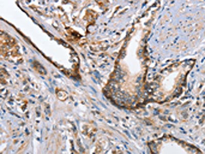 The image on the left is immunohistochemistry of paraffin-embedded Human prostate cancer tissue using MAD2L1BP Antibody(MAD2L1BP Antibody) at dilution 1/65, on the right is treated with fusion protein. (Original magnification: ×200)