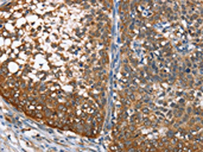 The image on the left is immunohistochemistry of paraffin-embedded Human cervical cancer tissue using the antibody Antibody) at dilution 1/65, on the right is treated with fusion protein. (Original magnification: ×200)