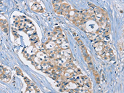 The image on the left is immunohistochemistry of paraffin-embedded Human breast cancer tissue using RAD51 Antibody(RAD51 Antibody) at dilution 1/25, on the right is treated with synthetic peptide. (Original magnification: ×200)Rabbit anti-Human RAD51 Polyclonal Antibody