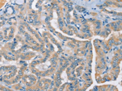 The image on the left is immunohistochemistry of paraffin-embedded Human thyroid cancer tissue using the antibody Antibody) at dilution 1/25, on the right is treated with synthetic peptide. (Original magnification: ×200)Rabbit anti-Human RAD51 Polyclonal Antibody