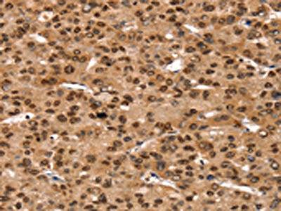 The image on the left is immunohistochemistry of paraffin-embedded Human liver cancer tissue using TAF10 Antibody(TAF10 Antibody) at dilution 1/35, on the right is treated with synthetic peptide. (Original magnification: ×200)Rabbit anti-Human TAF10 Polyclonal Antibody