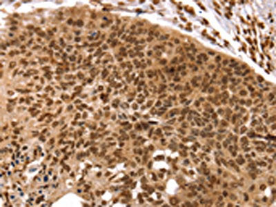 The image on the left is immunohistochemistry of paraffin-embedded Human esophagus cancer tissue using the antibody Antibody) at dilution 1/35, on the right is treated with synthetic peptide. (Original magnification: ×200)Rabbit anti-Human TAF10 Polyclonal Antibody