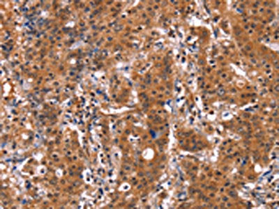 The image on the left is immunohistochemistry of paraffin-embedded Human gastric cancer tissue using GUK1 Antibody(GUK1 Antibody) at dilution 1/50, on the right is treated with synthetic peptide. (Original magnification: ×200)Rabbit anti-Human GUK1 Polyclonal Antibody