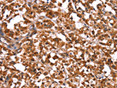 The image on the left is immunohistochemistry of paraffin-embedded Human thyroid cancer tissue using the antibody Antibody) at dilution 1/50, on the right is treated with synthetic peptide. (Original magnification: ×200)Rabbit anti-Human GUK1 Polyclonal Antibody