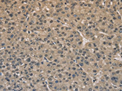 The image on the left is immunohistochemistry of paraffin-embedded Human liver cancer tissue using DRG1 Antibody(DRG1 Antibody) at dilution 1/20, on the right is treated with fusion protein. (Original magnification: ×200)Rabbit anti-Human DRG1 Polyclonal Antibody