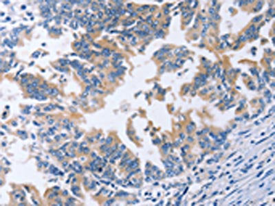 The image on the left is immunohistochemistry of paraffin-embedded Human gastric cancer tissue using AMACR Antibody(AMACR Antibody) at dilution 1/30, on the right is treated with fusion protein. (Original magnification: ×200)Rabbit anti-Human AMACR Polyclonal Antibody