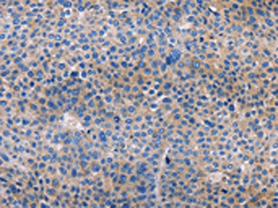 The image on the left is immunohistochemistry of paraffin-embedded Human liver cancer tissue using the antibody Antibody) at dilution 1/30, on the right is treated with fusion protein. (Original magnification: ×200)Rabbit anti-Human AMACR Polyclonal Antibody