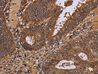 The image on the left is immunohistochemistry of paraffin-embedded Human colon cancer tissue using WDR83 Antibody(WDR83 Antibody) at dilution 1/30, on the right is treated with fusion protein. (Original magnification: ×200)Rabbit anti-Human WDR83 Polyclonal Antibody