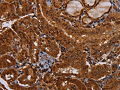 The image on the left is immunohistochemistry of paraffin-embedded Human thyroid cancer tissue using the antibody Antibody) at dilution 1/30, on the right is treated with fusion protein. (Original magnification: ×200)Rabbit anti-Human WDR83 Polyclonal Antibody