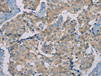 The image on the left is immunohistochemistry of paraffin-embedded Human breast cancer tissue using RAD51 Antibody(RAD51 Antibody) at dilution 1/40, on the right is treated with synthetic peptide. (Original magnification: ×200)Rabbit anti-Human RAD51 Polyclonal Antibody