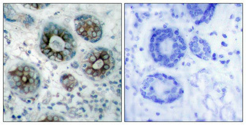 Immunohistochemical analysis of paraffin-embedded human breast carcinoma tissue using GAP43(Ab-41) Antibody(left) or the same antibody preincubated with blocking peptide(right).Rabbit anti-Human GAP43 Polyclonal Antibody