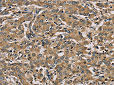 The image on the left is immunohistochemistry of paraffin-embedded Human liver cancer tissue using MYL3 Antibody(MYL3 Antibody) at dilution 1/45, on the right is treated with fusion protein. (Original magnification: ×200)Rabbit anti-Human MYL3 Polyclonal Antibody