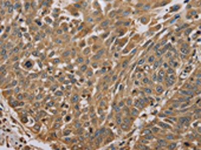 The image on the left is immunohistochemistry of paraffin-embedded Human lung cancer tissue using the antibody Antibody) at dilution 1/45, on the right is treated with fusion protein. (Original magnification: ×200)Rabbit anti-Human MYL3 Polyclonal Antibody