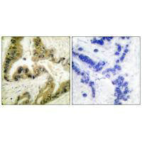 Immunohistochemical analysis of paraffin-embedded human lung carcinoma tissue using HDAC10 antibody.Rabbit anti-Human HDAC10 Polyclonal Antibody