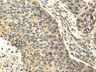 The image on the left is immunohistochemistry of paraffin-embedded Human esophagus cancer tissue using the antibody Antibody) at dilution 1/25, on the right is treated with fusion protein. (Original magnification: ×200)Rabbit anti-Human RASD2 Polyclonal Antibody