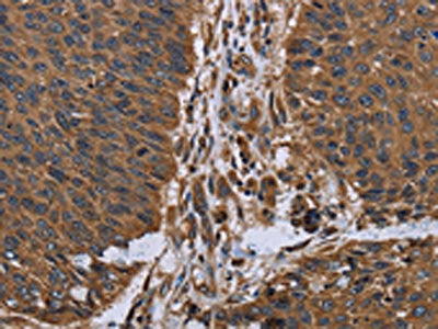 The image on the left is immunohistochemistry of paraffin-embedded Human lung cancer tissue using ITGA2B Antibody(ITGA2B Antibody) at dilution 1/40, on the right is treated with fusion protein. (Original magnification: ×200)