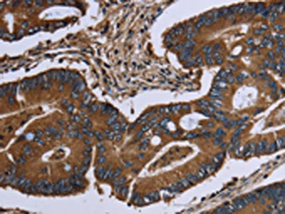 The image on the left is immunohistochemistry of paraffin-embedded Human colon cancer tissue using the antibody Antibody) at dilution 1/40, on the right is treated with fusion protein. (Original magnification: ×200)