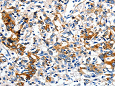 The image on the left is immunohistochemistry of paraffin-embedded Human gastric cancer tissue using LRP1 Antibody(LRP1  Antibody) at dilution 1/50, on the right is treated with synthetic peptide. (Original magnification: ×200)