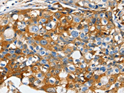 The image on the left is immunohistochemistry of paraffin-embedded Human breast cancer tissue using the antibody  Antibody) at dilution 1/50, on the right is treated with synthetic peptide. (Original magnification: ×200)