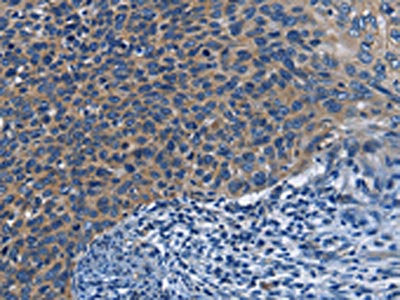 The image on the left is immunohistochemistry of paraffin-embedded Human cervical cancer tissue using KLRB1 Antibody(KLRB1 Antibody) at dilution 1/40, on the right is treated with fusion protein. (Original magnification: ×200)
