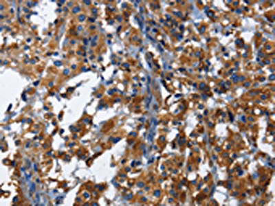 The image on the left is immunohistochemistry of paraffin-embedded Human thyroid cancer tissue using the antibody Antibody) at dilution 1/40, on the right is treated with fusion protein. (Original magnification: ×200)