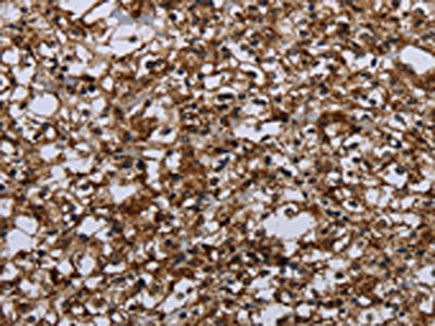 The image on the left is immunohistochemistry of paraffin-embedded Human prostate cancer tissue using HMGCL Antibody(HMGCL Antibody) at dilution 1/20, on the right is treated with fusion protein. (Original magnification: ×200)Rabbit anti-Human HMGCL Polyclonal Antibody