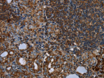 The image on the left is immunohistochemistry of paraffin-embedded Human thyroid cancer tissue using the antibody Antibody) at dilution 1/20, on the right is treated with fusion protein. (Original magnification: ×200)Rabbit anti-Human HMGCL Polyclonal Antibody