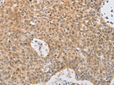 The image on the left is immunohistochemistry of paraffin-embedded Human lung cancer tissue using SERPINE2 Antibody(SERPINE2 Antibody) at dilution 1/20, on the right is treated with fusion protein. (Original magnification: ×200)Rabbit anti-Human SERPINE2 Polyclonal Antibody