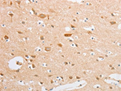 The image on the left is immunohistochemistry of paraffin-embedded Human brain tissue using the antibody Antibody) at dilution 1/20, on the right is treated with fusion protein. (Original magnification: ×200)Rabbit anti-Human SERPINE2 Polyclonal Antibody