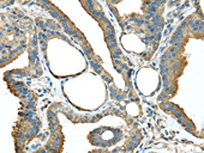 The image on the left is immunohistochemistry of paraffin-embedded Human thyroid cancer tissue using TMED1 Antibody(TMED1 Antibody) at dilution 1/35, on the right is treated with fusion protein. (Original magnification: ×200)Rabbit anti-Human TMED1 Polyclonal Antibody