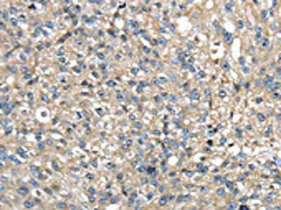 The image on the left is immunohistochemistry of paraffin-embedded Human breast cancer tissue using the antibody Antibody) at dilution 1/35, on the right is treated with fusion protein. (Original magnification: ×200)Rabbit anti-Human TMED1 Polyclonal Antibody