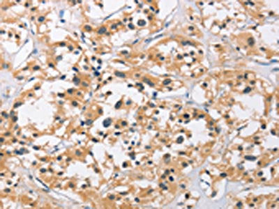 The image on the left is immunohistochemistry of paraffin-embedded Human thyroid cancer tissue using the antibody Antibody) at dilution 1/50, on the right is treated with fusion protein. (Original magnification: x200)