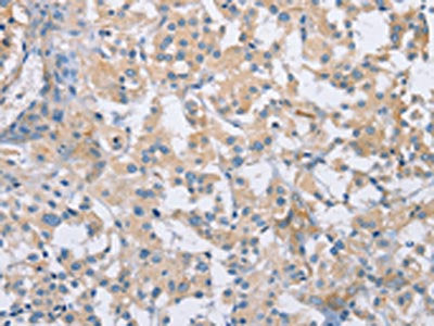 The image on the left is immunohistochemistry of paraffin-embedded Human thyroid cancer tissue using CDCP1 Antibody(CDCP1 Antibody) at dilution 1/50, on the right is treated with synthetic peptide. (Original magnification: ×200)Rabbit anti-Human CDCP1 Polyclonal Antibody