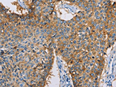 The image on the left is immunohistochemistry of paraffin-embedded Human lung cancer tissue using the antibody Antibody) at dilution 1/50, on the right is treated with synthetic peptide. (Original magnification: ×200)Rabbit anti-Human CDCP1 Polyclonal Antibody