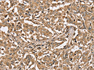 The image on the left is immunohistochemistry of paraffin-embedded Human liver cancer tissue using PPP1CC Antibody(PPP1CC Antibody) at dilution 1/40, on the right is treated with synthetic peptide. (Original magnification: ×200)Rabbit anti-Human PPP1CC Polyclonal Antibody