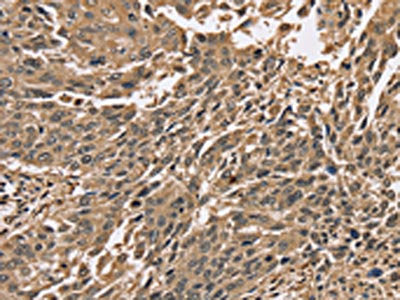 The image on the left is immunohistochemistry of paraffin-embedded Human lung cancer tissue using the antibody Antibody) at dilution 1/40, on the right is treated with synthetic peptide. (Original magnification: ×200)Rabbit anti-Human PPP1CC Polyclonal Antibody