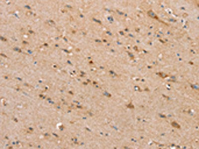 The image on the left is immunohistochemistry of paraffin-embedded Human brain tissue using SLC25A20 Antibody(SLC25A20 Antibody) at dilution 1/30, on the right is treated with synthetic peptide. (Original magnification: ×200)Rabbit anti-Human SLC25A20 Polyclonal Antibody