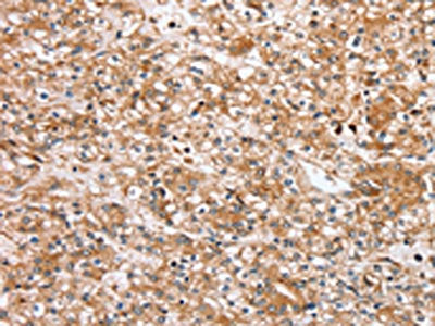 The image on the left is immunohistochemistry of paraffin-embedded Human prostate cancer tissue using the antibody Antibody) at dilution 1/30, on the right is treated with synthetic peptide. (Original magnification: ×200)Rabbit anti-Human SLC25A20 Polyclonal Antibody