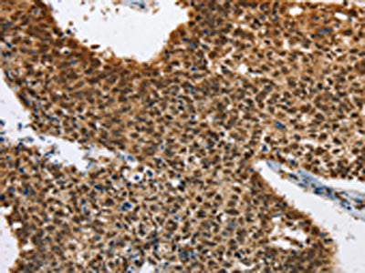 The image on the left is immunohistochemistry of paraffin-embedded Human lung cancer tissue using the antibody Antibody) at dilution 1/40, on the right is treated with fusion protein. (Original magnification: ×200)Rabbit anti-Human ELAVL1 Polyclonal Antibody