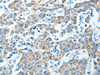 The image on the left is immunohistochemistry of paraffin-embedded Human breast cancer tissue using ALDH4A1 Antibody(ALDH4A1 Antibody) at dilution 1/35, on the right is treated with fusion protein. (Original magnification: ×200)Rabbit anti-Human ALDH4A1 Polyclonal Antibody