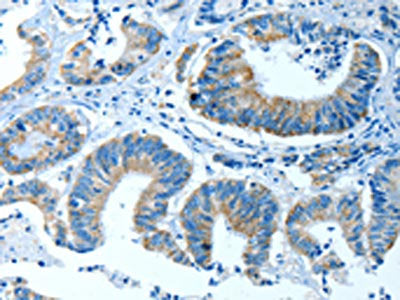 The image on the left is immunohistochemistry of paraffin-embedded Human colon cancer tissue using the antibody Antibody) at dilution 1/35, on the right is treated with fusion protein. (Original magnification: ×200)Rabbit anti-Human ALDH4A1 Polyclonal Antibody