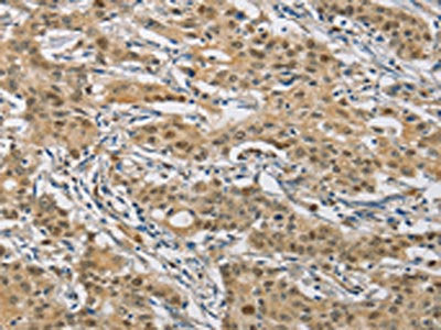 The image on the left is immunohistochemistry of paraffin-embedded Human gastric cancer tissue using NAPSA Antibody(NAPSA Antibody) at dilution 1/50, on the right is treated with fusion protein. (Original magnification: ×200)Rabbit anti-Human NAPSA Polyclonal Antibody