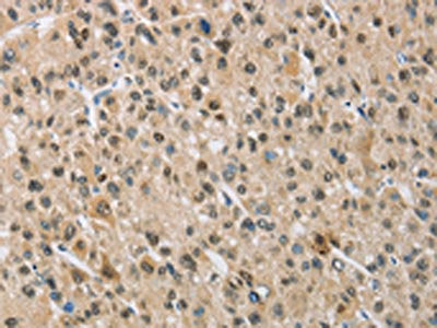 The image on the left is immunohistochemistry of paraffin-embedded Human liver cancer tissue using the antibody Antibody) at dilution 1/50, on the right is treated with fusion protein. (Original magnification: ×200)Rabbit anti-Human NAPSA Polyclonal Antibody