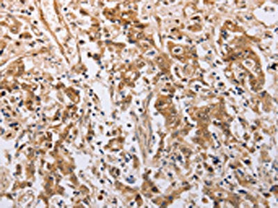 The image on the left is immunohistochemistry of paraffin-embedded Human gastric cancer tissue using PSMD3 Antibody(PSMD3 Antibody) at dilution 1/25, on the right is treated with fusion protein. (Original magnification: ×200)Rabbit anti-Human PSMD3 Polyclonal Antibody