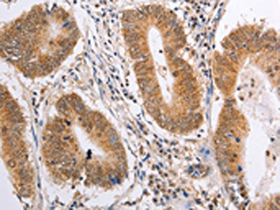 The image on the left is immunohistochemistry of paraffin-embedded Human colon cancer tissue using the antibody Antibody) at dilution 1/25, on the right is treated with fusion protein. (Original magnification: ×200)Rabbit anti-Human PSMD3 Polyclonal Antibody
