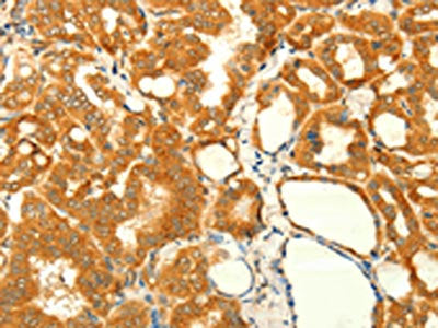 The image on the left is immunohistochemistry of paraffin-embedded Human thyroid cancer tissue using NAPA Antibody(NAPA Antibody) at dilution 1/35, on the right is treated with fusion protein. (Original magnification: ×200)Rabbit anti-Human NAPA Polyclonal Antibody