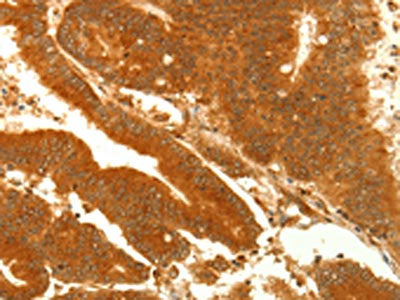 The image on the left is immunohistochemistry of paraffin-embedded Human colon cancer tissue using the antibody Antibody) at dilution 1/35, on the right is treated with fusion protein. (Original magnification: ×200)Rabbit anti-Human NAPA Polyclonal Antibody