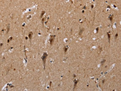 The image on the left is immunohistochemistry of paraffin-embedded Human brain  tissue using GTF2I Antibody(GTF2I Antibody) at dilution 1/40, on the right is treated with synthetic peptide. (Original magnification: ×200)Rabbit anti-Human GTF2I Polyclonal Antibody