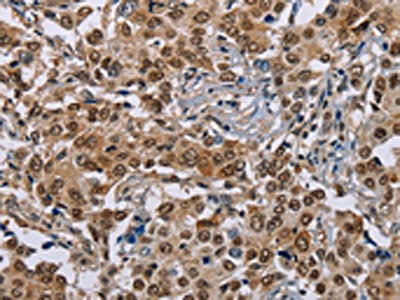 The image on the left is immunohistochemistry of paraffin-embedded Human liver cancer tissue using the antibody Antibody) at dilution 1/40, on the right is treated with synthetic peptide. (Original magnification: ×200)Rabbit anti-Human GTF2I Polyclonal Antibody